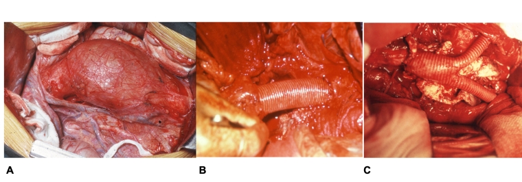 229_Fernandes_Figure 1_Abdominal aortic aneurysms.jpg