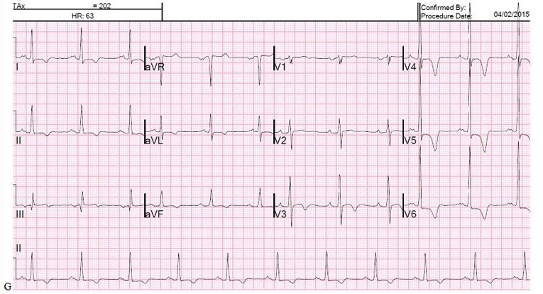 Case_Image_ECG apical-HCM_Jan2016_big_escardio-hPhotoLarge.jpg